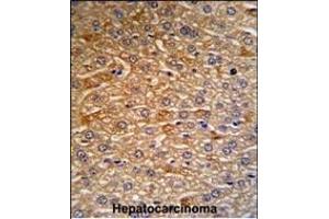 HRG Antibody (N-term) (R) IHC analysis in formalin fixed and paraffin embedded human hepatocarcinoma tissue followed by peroxidase conjugation of the secondary antibody and DAB staining.
