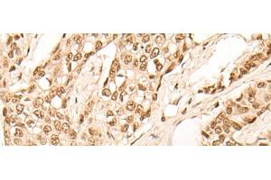 Immunohistochemistry of paraffin-embedded Human breast cancer tissue using EIF4A3 Polyclonal Antibody at dilution of 1:45(x200) (EIF4A3 Antikörper)