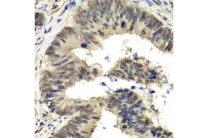 Immunohistochemistry of paraffin-embedded human colon carcinoma using NELFE antibody at dilution of 1:100 (x40 lens). (RDBP Antikörper)