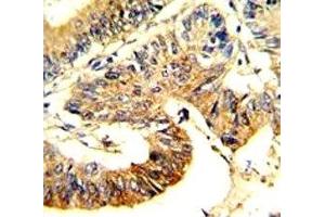 IHC analysis of FFPE human colon carcinoma stained with ASS1 antibody (ASS1 Antikörper  (AA 192-221))