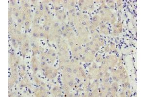 Immunohistochemistry of paraffin-embedded human liver cancer using ABIN7159626 at dilution of 1:100 (MCCC2 Antikörper  (AA 284-563))
