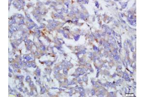 Formalin-fixed and paraffin embedded human lung cancer labeled with Anti-Complement C4/C4 Polyclonal Antibody, Unconjugated  at 1:200 followed by conjugation to the secondary antibody and DAB staining (Complement C4 Antikörper  (AA 701-800))