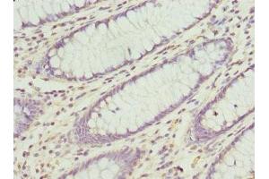 Immunohistochemistry of paraffin-embedded human colon cancer using ABIN7148782 at dilution of 1:100 (CXXC4 Antikörper  (AA 1-198))