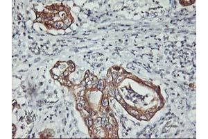 Immunohistochemical staining of paraffin-embedded Carcinoma of Human pancreas tissue using anti-PDSS2 mouse monoclonal antibody.