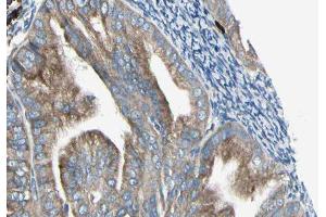 ABIN6279198 at 1/100 staining Human cervical cancer tissue by IHC-P. (BRI3 Antikörper  (N-Term))