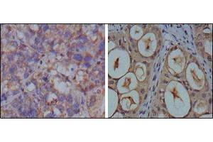 Immunohistochemical analysis of paraffin-embedded human breast carcinoma (left) and kidney carcinoma (right), showing cytoplasmic localization using GAPDH mouse mAb with DAB staining. (GAPDH Antikörper)