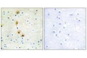 Immunohistochemistry analysis of paraffin-embedded human breast carcinoma tissue using Akt (Ab-326) antibody. (AKT1 Antikörper  (Tyr326))