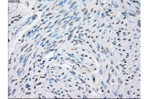 Immunohistochemical staining of paraffin-embedded Carcinoma of thyroid tissue using anti-STAT1 mouse monoclonal antibody. (STAT1 Antikörper)