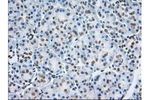 Immunohistochemical staining of paraffin-embedded Adenocarcinoma of Human colon tissue using anti-TACC3 mouse monoclonal antibody. (TACC3 Antikörper)