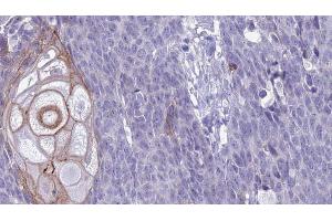 ABIN6272629 at 1/100 staining Human Head and neck cancer tissue by IHC-P. (KLRC2/4 Antikörper)