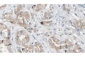 ABIN6279343 at 1/100 staining Human prostate tissue by IHC-P. (NT5C2 Antikörper)