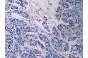 IHC-P analysis of Human Breast Cancer Tissue, with DAB staining. (FGFR3 Antikörper  (AA 166-375))