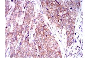 Immunohistochemical analysis of paraffin-embedded bladder cancer tissues using MARK3 mouse mAb with DAB staining. (MARK3 Antikörper  (AA 435-658))
