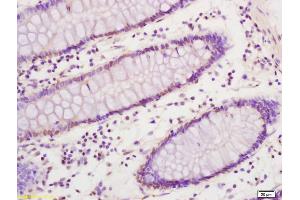 Formalin-fixed and paraffin embedded human colon carcinoma labeled with Anti SREBP-1 Polyclonal Antibody, Unconjugated (ABIN686032) at 1:200 followed by conjugation to the secondary antibody and DAB staining (Srebp-1/2 (AA 301-450) Antikörper)