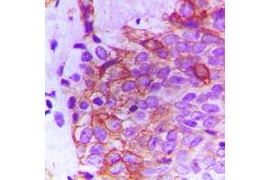 Immunohistochemical analysis of FGFR2 staining in human breast cancer formalin fixed paraffin embedded tissue section. (FGFR2 Antikörper  (Center))