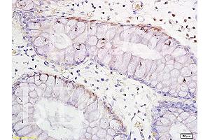 Formalin-fixed and paraffin embedded human colitis tissue labeled with Anti-TNF-alpha Polyclonal Antibody, Unconjugated (ABIN724565) 1:300 followed by conjugation to the secondary antibody and DAB staining