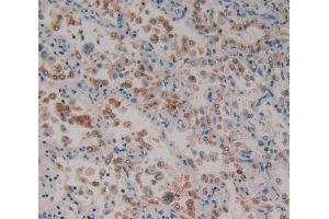 IHC-P analysis of lung cancer tissue, with DAB staining. (Paxillin Antikörper  (AA 201-461))