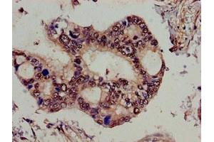 Immunohistochemistry of paraffin-embedded human pancreatic cancer using ABIN7159025 at dilution of 1:100 (SPG21 Antikörper  (AA 1-308))