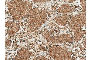 Immunohistochemistry analysis using Rabbit Anti-ROR1 Polyclonal Antibody (ABIN5667806). (ROR1 Antikörper  (AA 200-300) (PerCP))