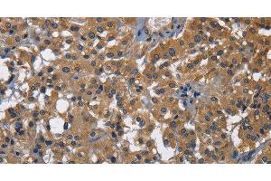Immunohistochemistry of paraffin-embedded Human thyroid cancer using CD160 Polyclonal Antibody at dilution of 1:30 (CD160 Antikörper)