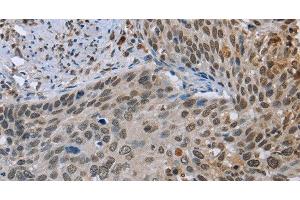 Immunohistochemistry of paraffin-embedded Human cervical cancer tissue using NMT1 Polyclonal Antibody at dilution 1:45 (NMT1 Antikörper)