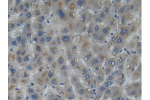 DAB staining on IHC-P; Samples: Human Liver cancer Tissue (Myosin IA Antikörper  (AA 781-1043))