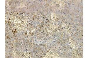 ABIN6264741 and ABIN6274043 at 1/100 staining human melanoma by IHC-P. (RhoA,B,C (C-Term) Antikörper)