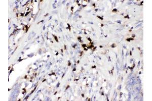 ORM1 was detected in paraffin-embedded sections of human intestinal cancer tissues using rabbit anti- ORM1 Antigen Affinity purified polyclonal antibody (Catalog # ) at 1 ? (ORM1 Antikörper  (AA 19-201))