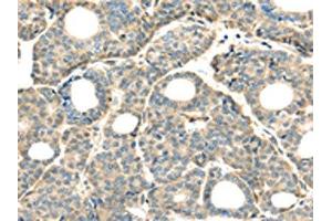 The image on the left is immunohistochemistry of paraffin-embedded Human thyroid cancer tissue using ABIN7128031(THAP2 Antibody) at dilution 1/20, on the right is treated with fusion protein. (THAP2 Antikörper)