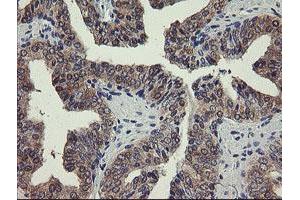 Immunohistochemical staining of paraffin-embedded Human prostate tissue using anti-PGM3 mouse monoclonal antibody. (Phosphoglucomutase 3 Antikörper)