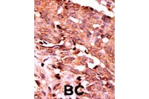 Formalin-fixed and paraffin-embedded human cancer tissue reacted with CASP6 (phospho S257) polyclonal antibody  which was peroxidase-conjugated to the secondary antibody followed by AEC staining.