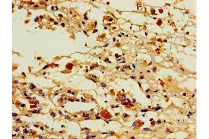 Immunohistochemistry of paraffin-embedded human melanoma using ABIN7164848 at dilution of 1:100 (PTGIS Antikörper  (AA 113-199))