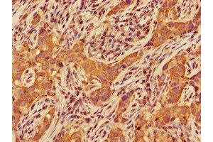 Immunohistochemistry of paraffin-embedded human pancreatic cancer using ABIN7147455 at dilution of 1:100 (CERK Antikörper  (AA 212-478))
