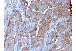 Formalin-fixed, paraffin-embedded human Colon Carcinoma stained with MerTK Mouse Monoclonal Antibody (MERTK/3022). (MERTK Antikörper  (AA 55-148))