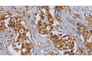 Immunohistochemistry of paraffin-embedded Human breast cancer using PUS10 Polyclonal Antibody at dilution of 1:45 (PUS10 Antikörper)