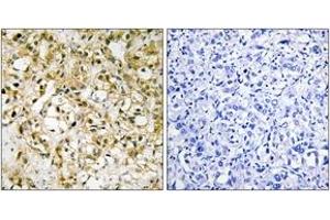 Immunohistochemistry analysis of paraffin-embedded human liver carcinoma tissue, using TFAM Antibody. (TFAM Antikörper  (AA 131-180))