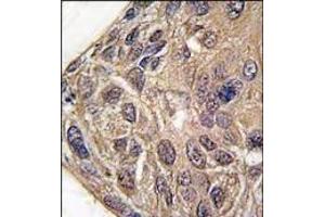 Formalin-fixed and paraffin-embedded human lung carcinoma tissue reacted with YARS antibody (C-term), which was peroxidase-conjugated to the secondary antibody, followed by DAB staining. (YARS Antikörper  (C-Term))