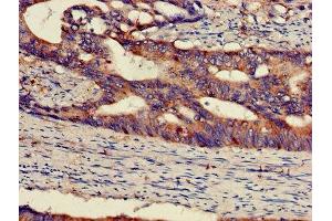 IHC image of ABIN7150697 diluted at 1:300 and staining in paraffin-embedded human colon cancer performed on a Leica BondTM system. (MEK1 Antikörper  (AA 2-79))