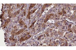 ABIN6277689 at 1/100 staining Human liver cancer tissue by IHC-P. (BMPR2 Antikörper  (Internal Region))