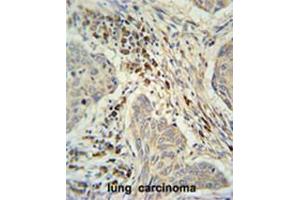 C19orf50 Antibody (Center) immunohistochemistry analysis in formalin fixed and paraffin embedded human lung carcinoma followed by peroxidase conjugation of the secondary antibody and DAB staining. (C19orf50 Antikörper  (Middle Region))
