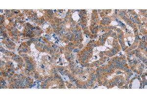 Immunohistochemistry of paraffin-embedded Human thyroid cancer using POMT1 Polyclonal Antibody at dilution of 1:50 (POMT1 Antikörper)