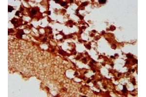 IHC image of ABIN7163270 diluted at 1:400 and staining in paraffin-embedded human melanoma performed on a Leica BondTM system. (PACS2 Antikörper  (AA 268-465))