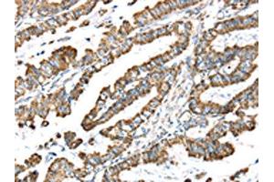 The image on the left is immunohistochemistry of paraffin-embedded Human esophagus cancer tissue using ABIN7191329(LTB4R2 Antibody) at dilution 1/20, on the right is treated with synthetic peptide. (LTB4R2 Antikörper)