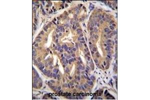 GTF2H2C Antibody (C-term) (ABIN655372 and ABIN2844928) immunohistochemistry analysis in formalin fixed and paraffin embedded human prostate carcinoma followed by peroxidase conjugation of the secondary antibody and DAB staining.