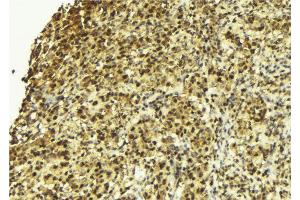 ABIN6273126 at 1/100 staining Human breast cancer tissue by IHC-P. (HDGFRP2 Antikörper)