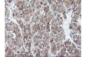 Immunohistochemical staining of paraffin-embedded Carcinoma of Human liver tissue using anti-RPN1 mouse monoclonal antibody. (RPN1 Antikörper)