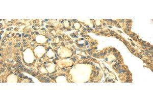 Immunohistochemistry of paraffin-embedded Human thyroid cancer using SDHA Polyclonal Antibody at dilution of 1/40 (SDHA Antikörper)