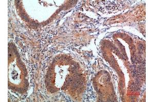 Immunohistochemical analysis of paraffin-embedded human-colon-cancer, antibody was diluted at 1:200 (PDGFC Antikörper  (AA 61-110))