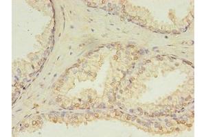 Immunohistochemistry of paraffin-embedded human prostate cancer using ABIN7154764 at dilution of 1:100 (HDDC3 Antikörper  (AA 2-140))