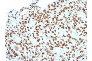 Formalin-fixed, paraffin-embedded human Breast Carcinoma stained with BMI1 Mouse Monoclonal Antibody (BMI1/2823). (BMI1 Antikörper  (AA 142-326))